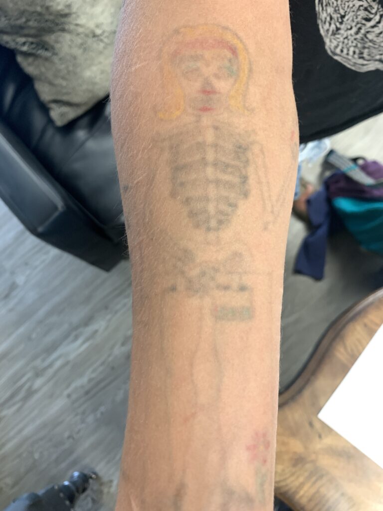 Lasers Don't Remove Tattoos
